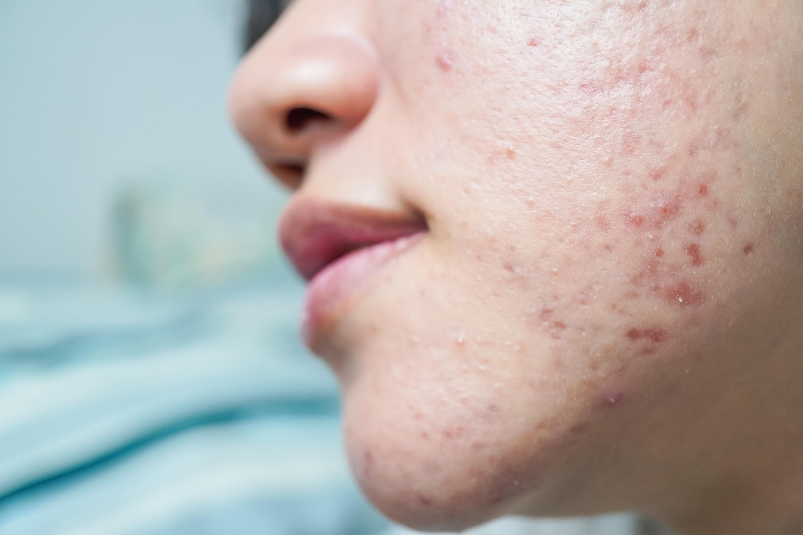 Boutons et microkystes dus à de l’acné hormonale
